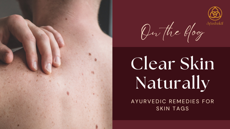 Clear Skin Naturally – Ayurvedic Remedies for Skin Tags – Ayushakti India