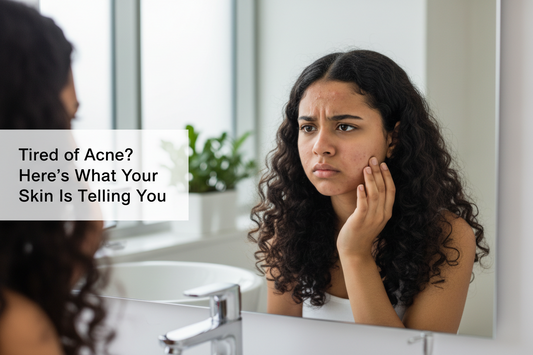 Tired of Acne? Here’s What Your Skin Is Telling You