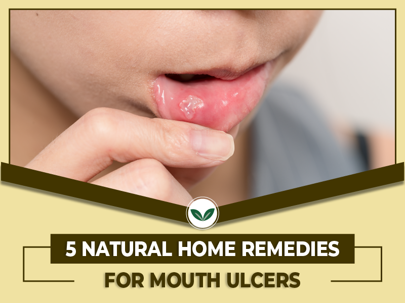 5 Natural Home Remedies for Mouth Ulcers