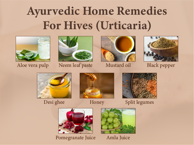 hives treatment at home