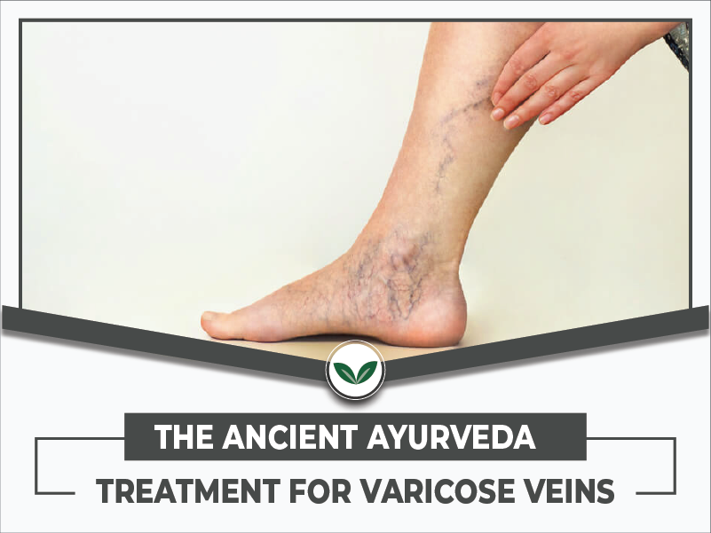 Ayurvedic Treatment for Varicose Vein